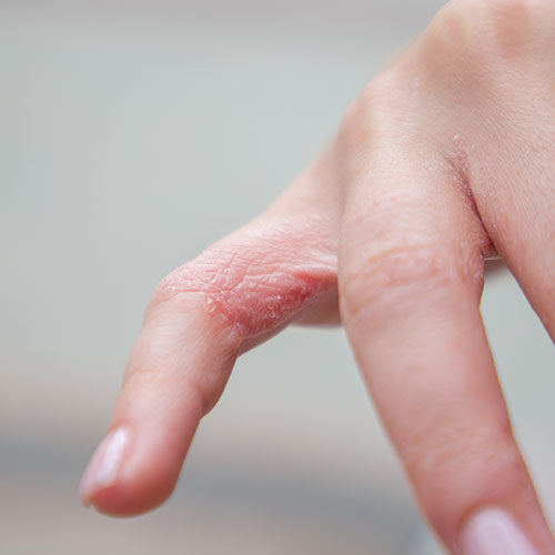 Close-up of a hand with a dry skin