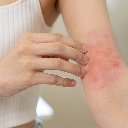 Person scratching an itchy arm with visible redness